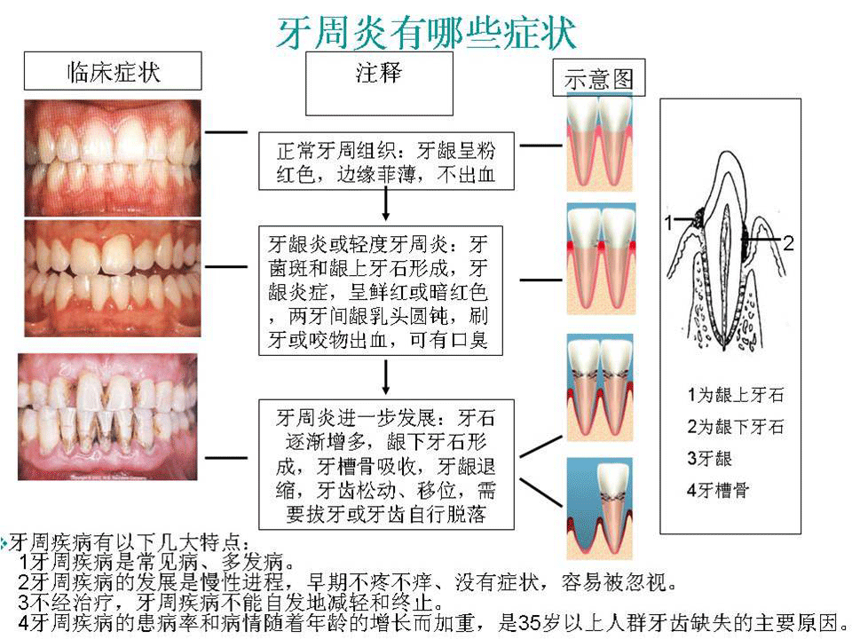 牙周炎有哪些症状